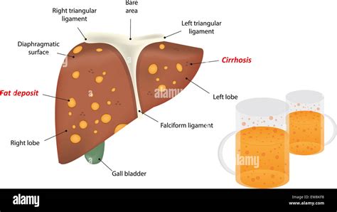 Alcohol Related Liver Disease Stock Photo - Alamy