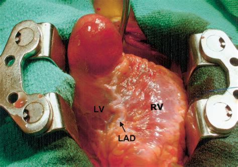 Figure From Left Ventricular Aneurysm Associated With