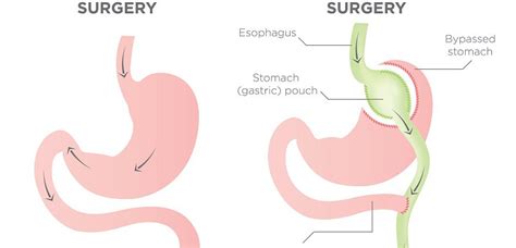 Laparoscopic Weight Loss Surgery Procedures Blog Dandk