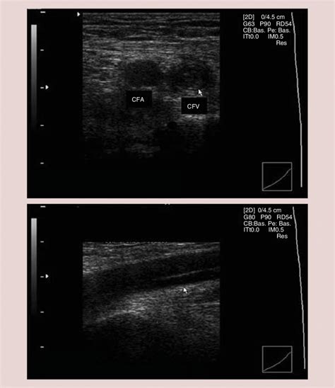 Ultrasound detection of deep vein thrombosis. On the top: deep vein ...