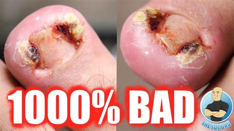 INSANE OVERGROWN INFECTED TOENAIL REMOVAL YouTube