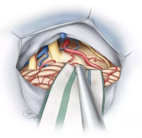 岩尖脑膜瘤手术策略与技巧 The Neurosurgical Atlas全文翻译 脑医汇 神外资讯 神介资讯