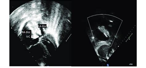 Using transthoracic echo during the procedure; the device in good... | Download Scientific Diagram