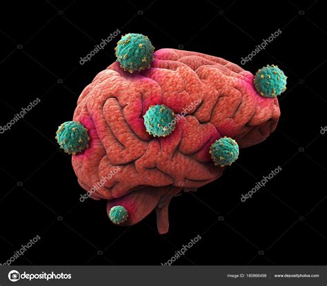 Human Brain Cancer Cells Spreading Growing Malignant Cells Caused ...