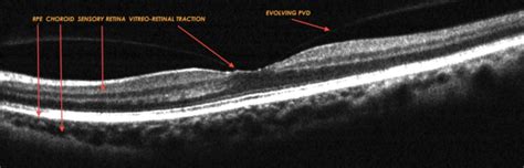 Optical Coherence Tomography Oct Scan