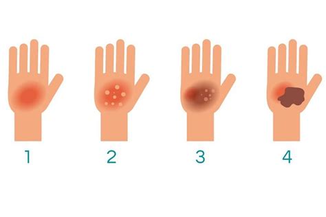 Как лечить ожоги: солнечные, химические, термические