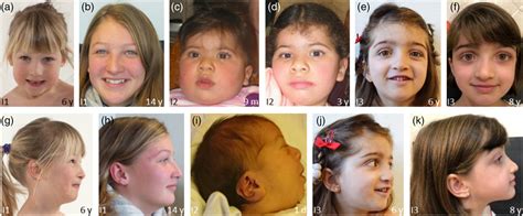 Variable Pulmonary Manifestations In Chitayat Syndrome Six Additional