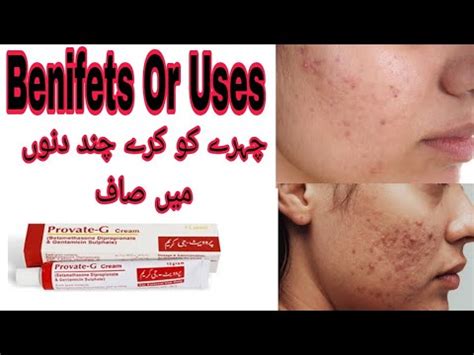 Provate G Cream Uses For Acne S Scar S Benefits Side Effects In Urdu