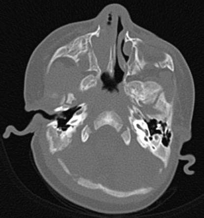 Choanal atresia | Radiology Reference Article | Radiopaedia.org