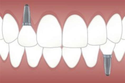 My Dental Implant Fell Off Now What Dental Town DC Cosmetic Dentists