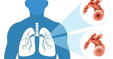 Understanding the Common Symptoms of Asthma - NowServing Health