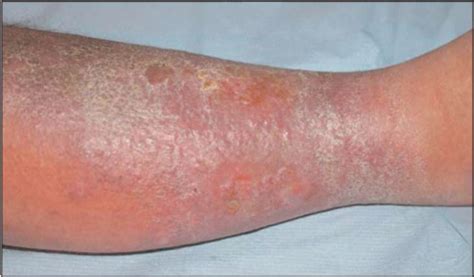 Leg ulcers and wound healing | Plastic Surgery Key