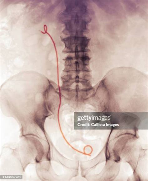 Ureteral Stent Photos And Premium High Res Pictures Getty Images