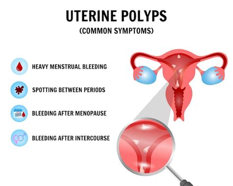 Premium Vector Medical Infographic Uterine Polyps Disease In Vector