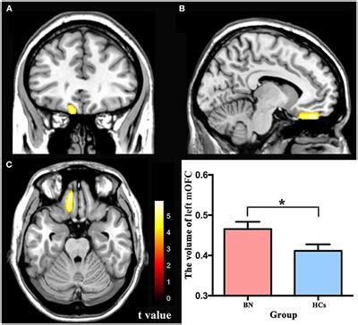 Frontiers Altered Gray Matter Volume And Functional Connectivity In