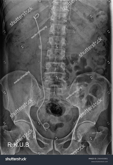 kub  ray showing ureteral stent placement stock photo