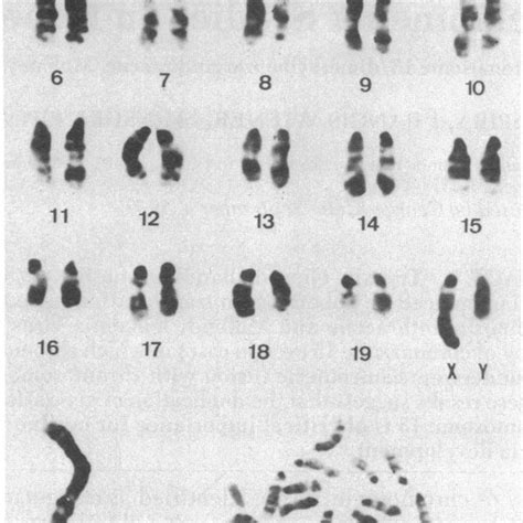 Trypsin Giemsa Banded Karyotype And Metaphase Plate Of A Leukemic Cell