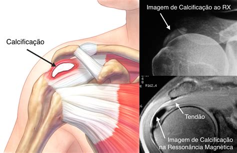 Ortopedista Curitiba Tendinite Calcaria No Ombro Dr Carlos