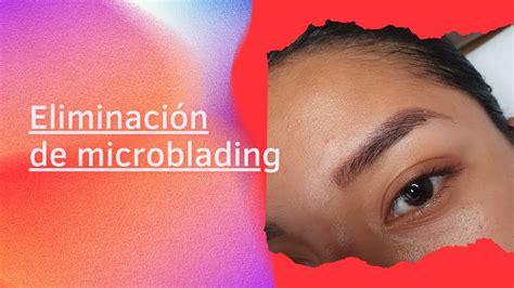 Eliminaci N De Microblading Con Laser Youtube