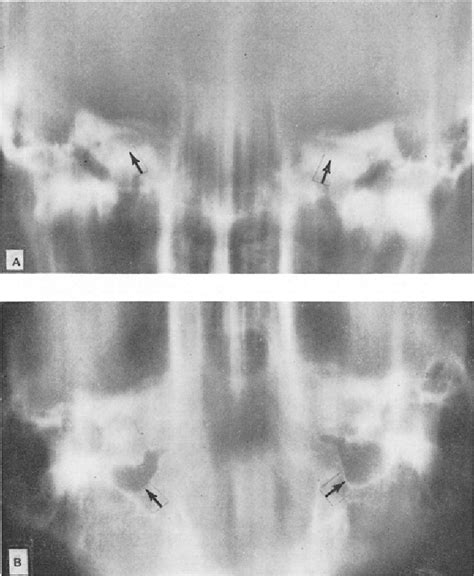 Figure 1 From The Jugular Foramen Semantic Scholar