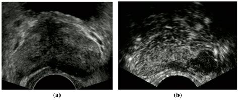 Transrectal Ultrasound Procedure