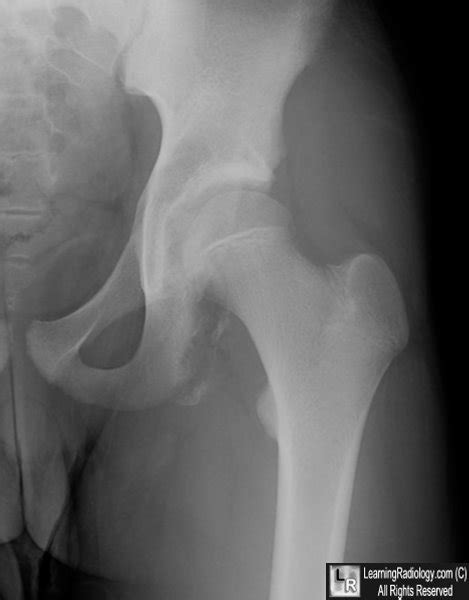 Learningradiology Pelvic Avulsion Fractures