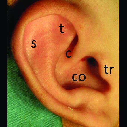 Auricular cartilage graft donor sites. s, scapha; t, triangular fossa ...