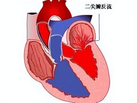 做完心脏彩超，提示二尖瓣或三尖瓣狭窄，二尖瓣返流，严重吗？心房二尖瓣左心室血液治疗 健康界