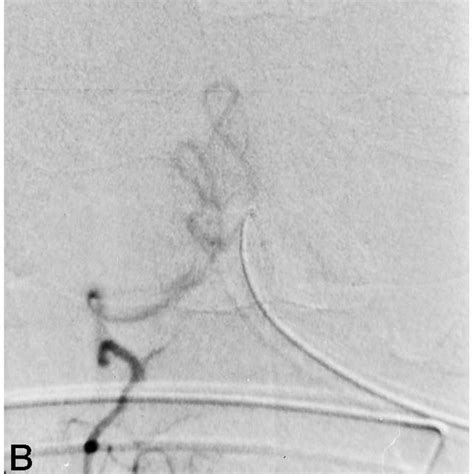 Case Proximal Basilar Thrombosis With Collateral Filling Of The