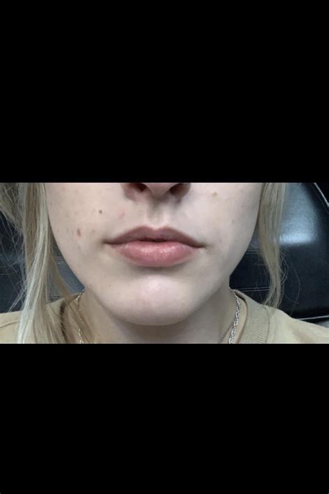 My Lip Filler Journey R Plasticsurgery