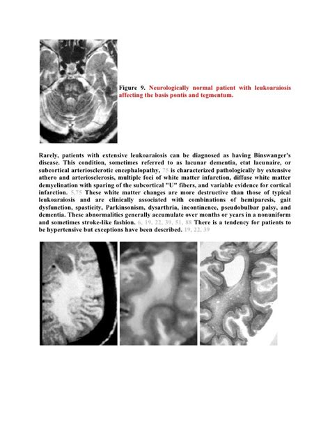 Radiological Pathology Of Microvascular Brain Disease