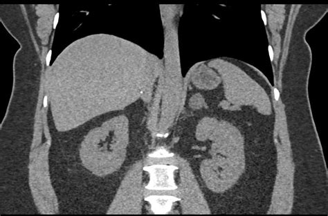 Bilateral Adrenal Adenomas Adrenal Case Studies Ctisus Ct Scanning