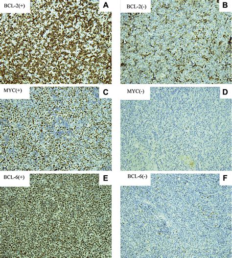 Prognostic Significance Of BCL 2 And BCL 6 Expression In MYC Positive