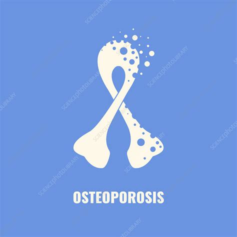 Osteoporosis Conceptual Illustration Stock Image F