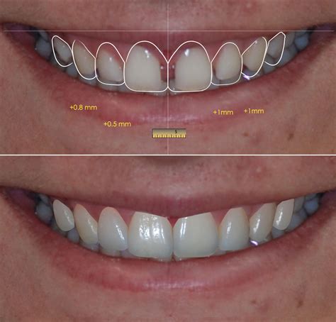 Dise O Digital De Sonrisas Gnatos Cl Nica Dental