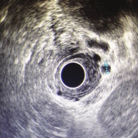 Esophageal Mucosa Esophageal Submucosal Paraesophageal Varices Were