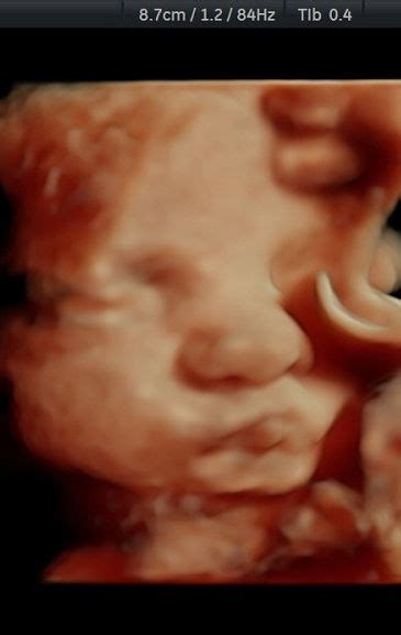 The Differences Between 2d 3d And 4d Ultrasounds 60 Off