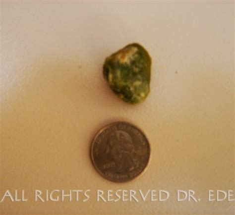 Gallstone Pictures Gallery See Images Of Real Gallstones Passed