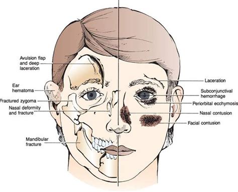 Periorbital Ecchymosis Pictures Symptoms Causes Treatment
