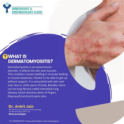 Myositis Skin Rash