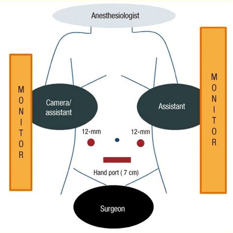 Operating Room Setup For Hand Assisted Laparoscopic Anterior Resection