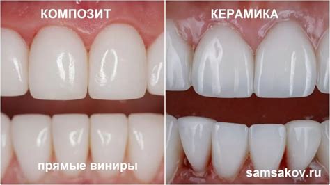 Какие виниры лучше - прямые или керамические? | Альянс бьюти ...