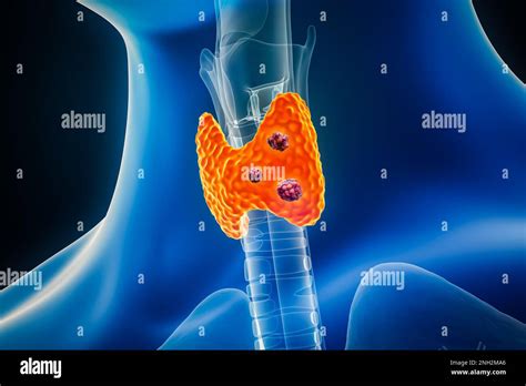 Thyroid Cancer With Organs And Tumors Or Cancerous Cells 3d Rendering Illustration With Male