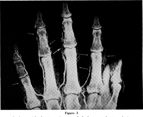 Figure 1 From Digital Arteriography In Occlusive Arterial Disease And