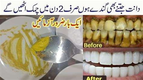 Teeth Cleaning At Home Easy Teeth Whitening Remedy Dant Saaf Karne