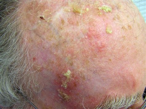 Actinic Keratosis Pictures And Photos