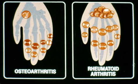 Osteoarthritis Flashcards Quizlet