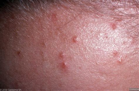 Pityrosporum Folliculitis Picture Pictures Photos