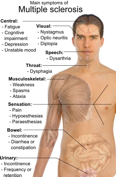 What Are The Symptoms Of Ms