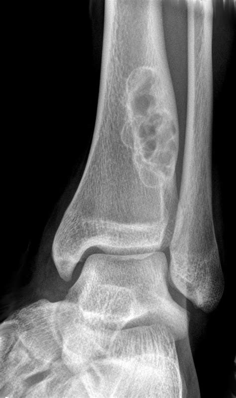 Ossifying Fibroma Tibia